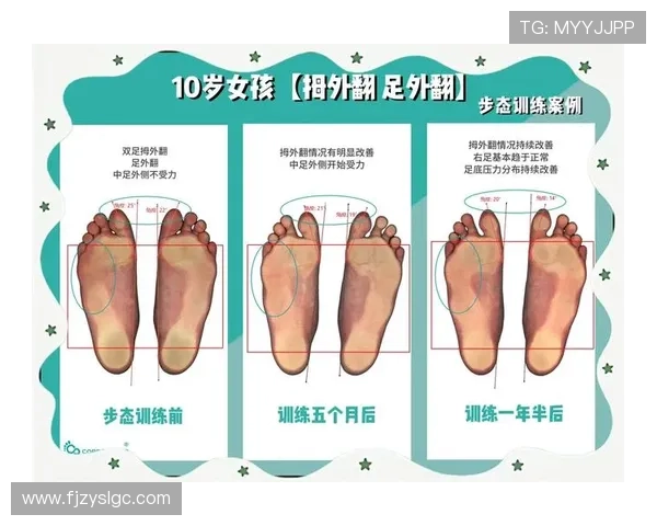 拇外翻困扰足球明星的职业生涯与健康管理探讨